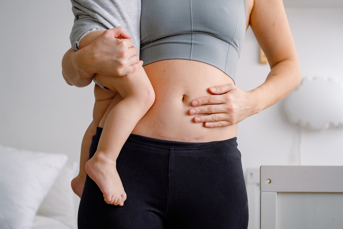 Close up of a belly with scar from c-section. A woman holding a baby showing her imperfect body. An abdomen with scar from Caesarian section. Close up of a belly with scar from c-section. A woman holding a baby showing her imperfect body. An abdomen with scar from Caesarian section.